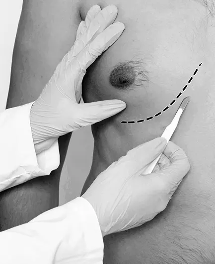 Treatment-of-breast-enlargement-in-men